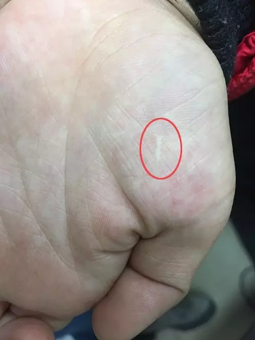 小宝被割开的右手掌(现已快愈合) 孙朝晖主任供图