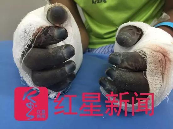 ▲5月28日,红星新闻记者在加德满都一家高级医院见到了被救的桑吉,他的十个手指头可能难以保留