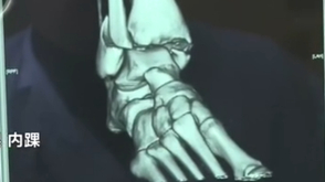 女孩模仿短视频摔断腿