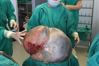 女子体内取出68斤重巨型肿瘤
