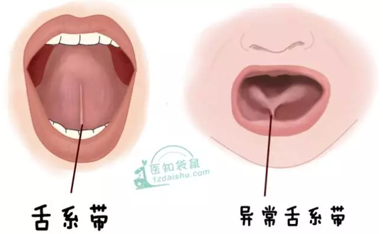 宝宝是这种舌头吗?如果是,要小心了!|舌系带|宝