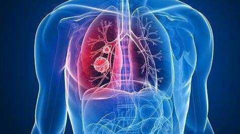 肺癌早期的8个信号, 肺癌扩散的5大征兆,千万别忽视!