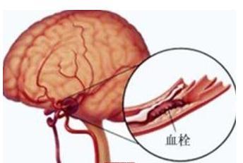 5个征兆说明脑血管堵塞了，是脑血栓的前兆，早送医