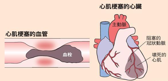 医生告诫：4个征兆说明你的血管堵塞，血液粘稠如粥