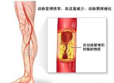 医生告诫：4个征兆说明你的血管堵塞，血液粘稠如粥