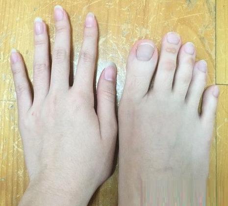 女大学生“脚趾长成了手”，被人称“稀有动物”，网友：用着真棒