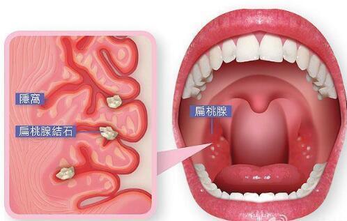 感觉咽喉有异物, 吃饭时却咳出小石头! 这是怎么回事?