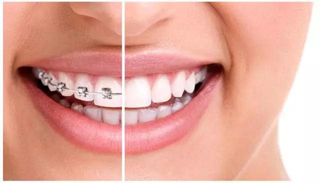 牙科医生任欢告诉你：传统矫正与隐形矫正有什么区别！