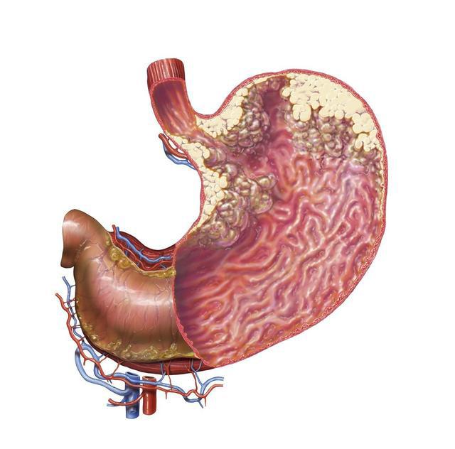 记住：5个胃癌必定出现的前兆，准确识别胃癌，赶紧看医生！