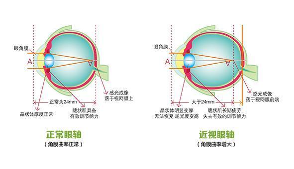 你的眼睛近视的过程中到底发生了哪些变化？（原理篇）