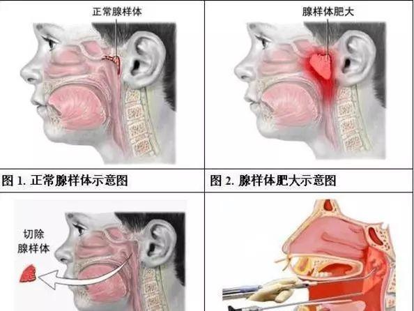 孩子张嘴睡觉  爱翻身  不重视有可能造成听力下降