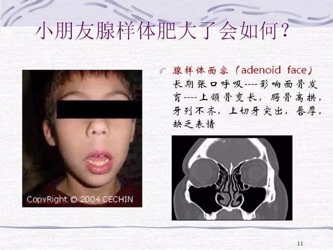 孩子张嘴睡觉  爱翻身  不重视有可能造成听力下降