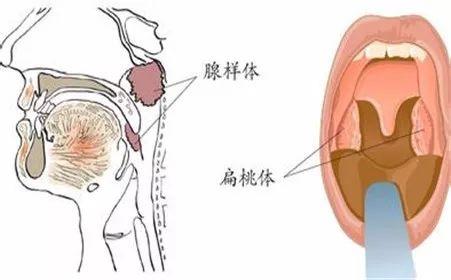 孩子张嘴睡觉  爱翻身  不重视有可能造成听力下降