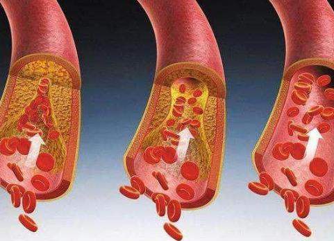 30岁以后血管和肠道该如何清理保护？