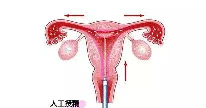 一代、二代、三代人授試管的區(qū)別全在這里!還有第四代試管技術(shù)!