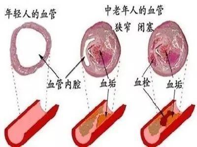 想要预防血管衰老，堵塞，这“四大雷区”要避开