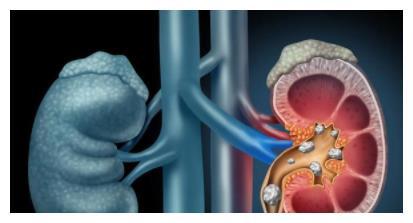 肾脏长了结石，5个生活“重点”，患者别抛诸脑后