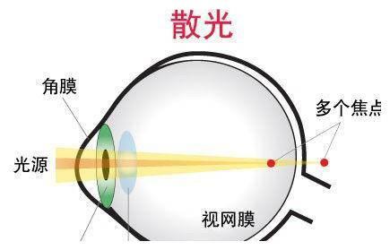 老花、散光、白内障都是看不清，应该如何区分？3招让你分清3者