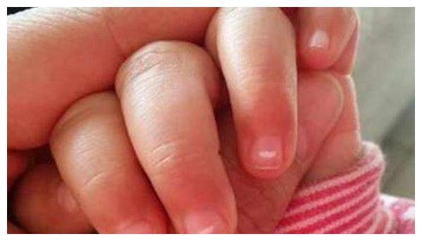 宝宝指甲出现这5种状态时，是宝宝身体有异常的信号，宝妈要注意
