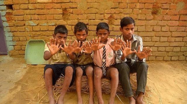 印度一家25人600只指头，个个都是六指，遗传的威力真大！