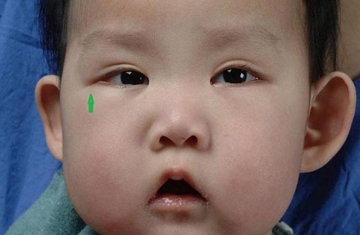 有一种病叫“孩子太漂亮”，天生自带眼妆，是产检查不出的罕见病