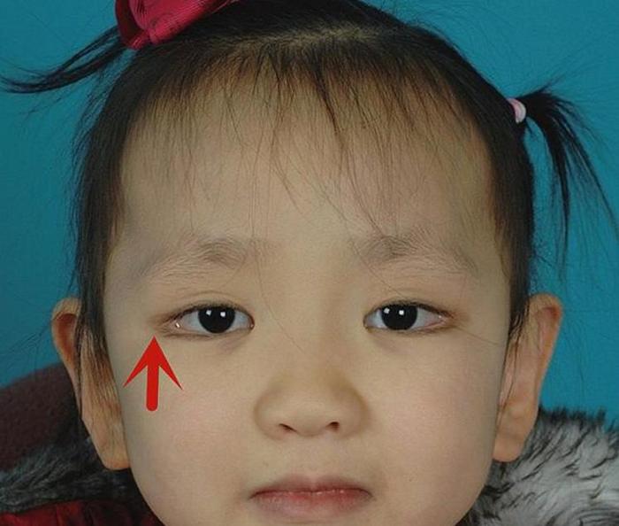 有一种病叫“孩子太漂亮”，天生自带眼妆，是产检查不出的罕见病