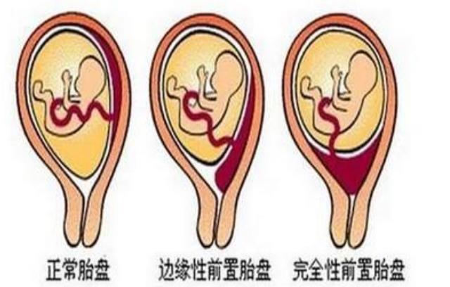 胎盘靠前和靠后，和胎儿性别有关吗？经验人告诉你实情