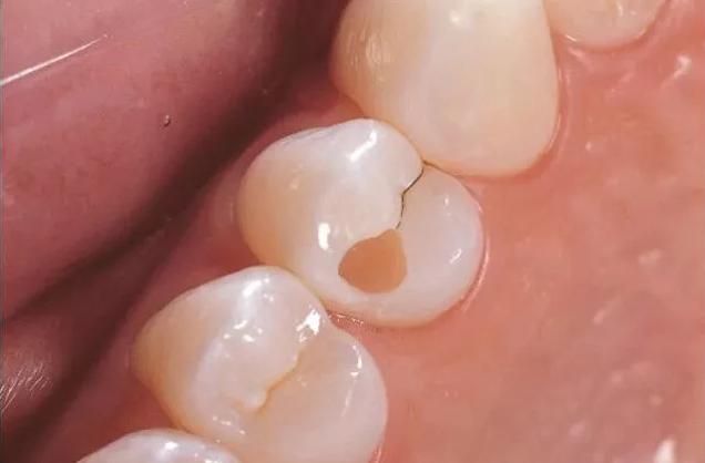 牙齿发现一个小洞洞，一定要去补牙吗？