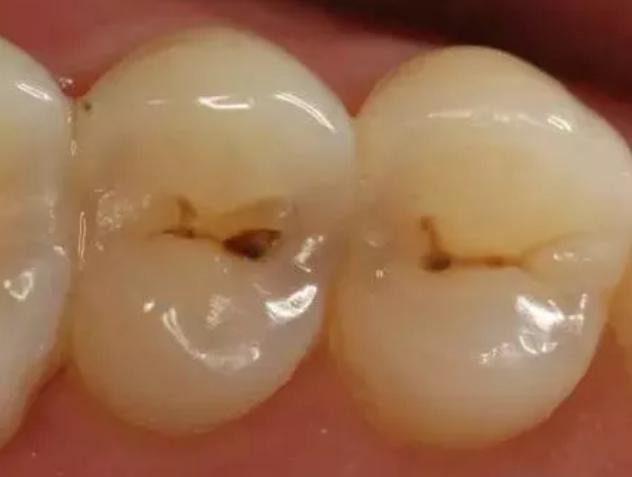 牙齿发现一个小洞洞，一定要去补牙吗？