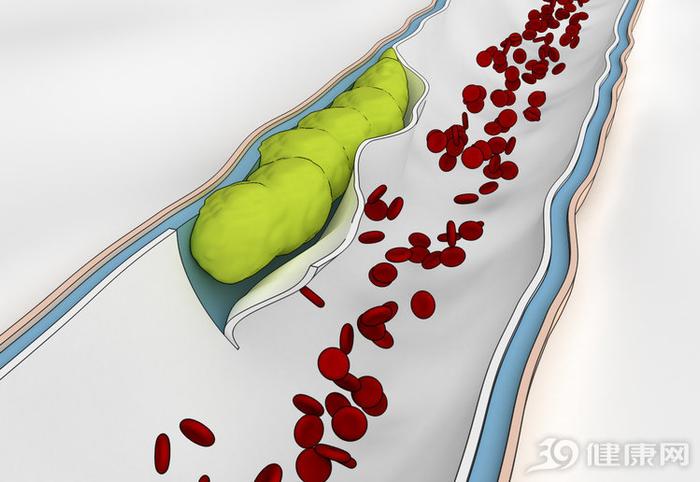 脑血栓能治好吗？5个后遗症，任谁都难以接受