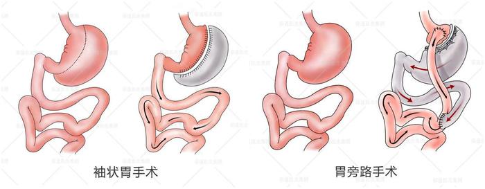 ​减重外科专家戴晓江答疑：用切胃手术减肥会有后遗症吗？