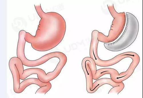 缩胃手术居然还可以预防肿瘤？