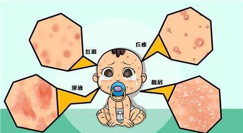 奶藓、痱子、荨麻疹、婴儿痤疮.....宝宝这些皮肤病你会处理吗？