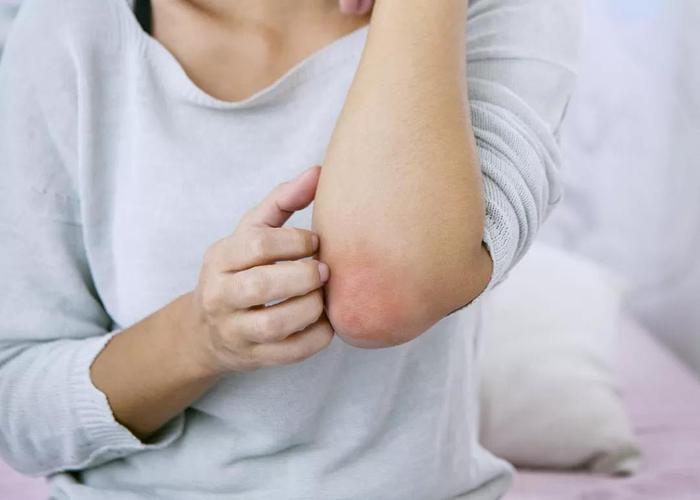 冬季如何预防荨麻疹，这五条很管用，调节过敏体质最关键