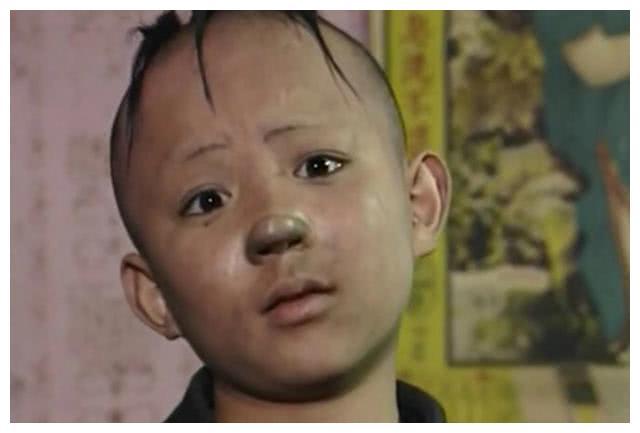 8岁演“三毛”，和孙俪是同学，14岁秃顶植发….
