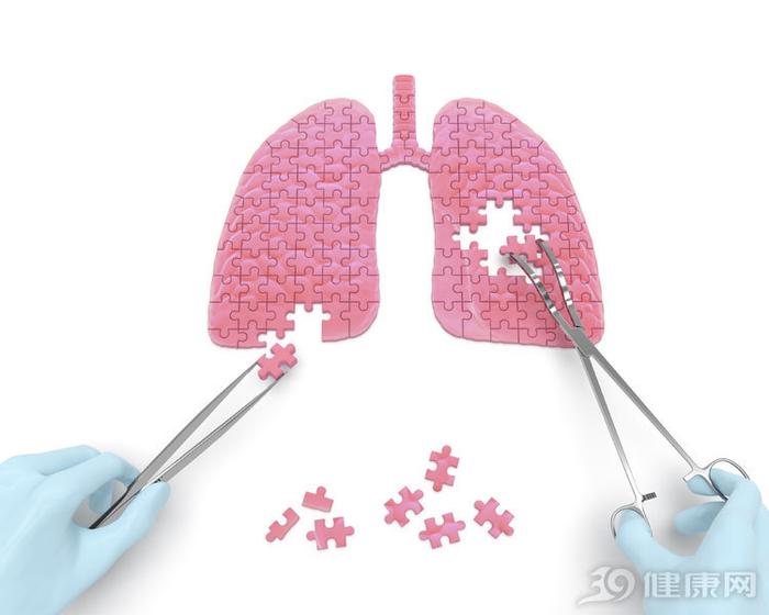 有了肺结节，下一步就是肺癌？