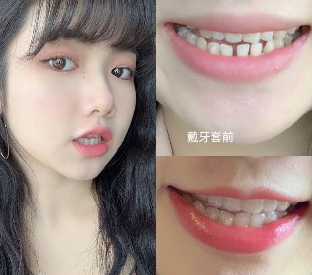 你们清洗隐形牙套的频率是多久？