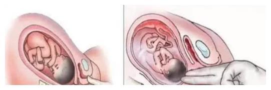 孕期被认最最最尴尬的检查：内检，孕妈你了解吗？