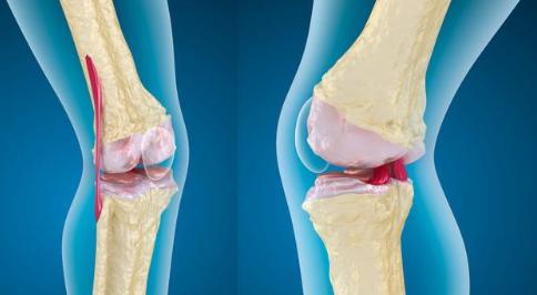 膝盖痛到不能忍？5个诱因，大多和疾病有关
