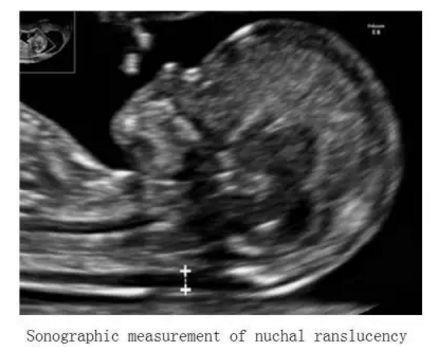 孕期检查，如何对宝宝染色体异常进行筛选？再省也别忽略这个项目
