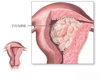 48岁女子绝经3年后又来例假重返青春？医生却让她赶快住院