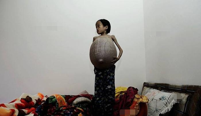 10岁女孩因为肚子大如气球，医院检查后，父母泪崩
