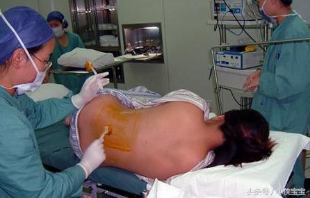 男人们来看看女人剖腹产用的麻醉针头有多粗，生孩子所受的痛