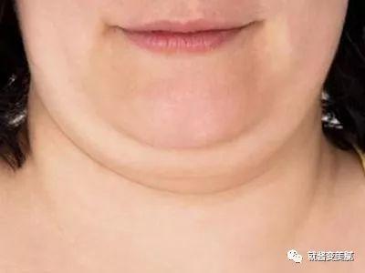 脖子粗只是因为胖？需警惕这6种病