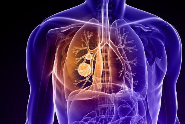 出现这种咳嗽, 别以为是感冒问题, 它可能是肺癌发出的信号!