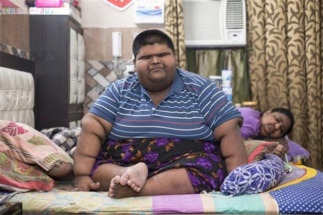 14岁474斤，被称为“世界上最胖的孩子”，胖到眼睛都睁不开