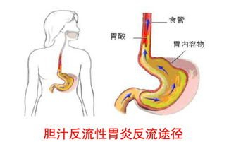 胆囊里的胆汁，怎么会返流到胃里面？胆汁返流性胃炎会癌变吗？