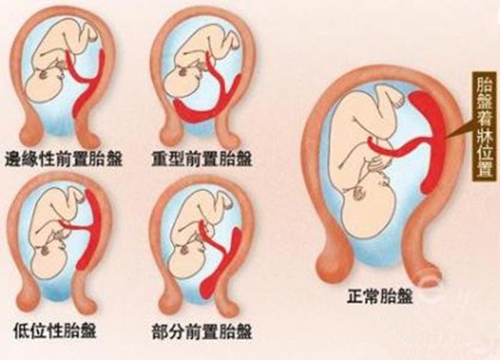 怀孕24周胎儿停育，B超显示胎宝处于中央性前置胎盘，孕妈要重视