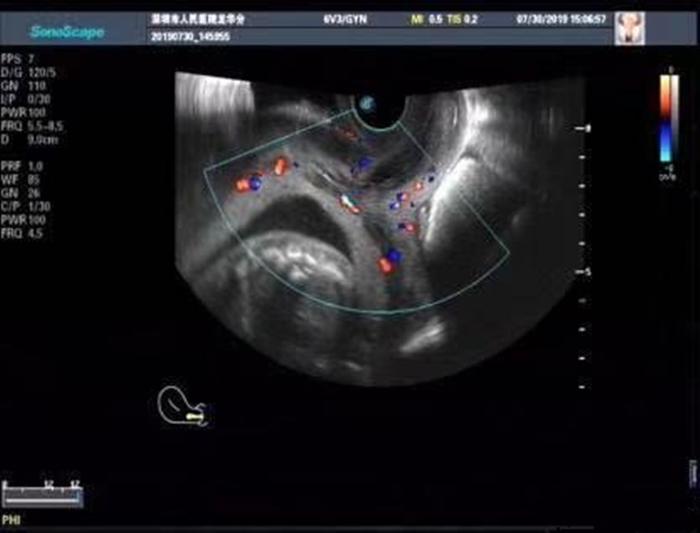 怀孕24周胎儿停育，B超显示胎宝处于中央性前置胎盘，孕妈要重视