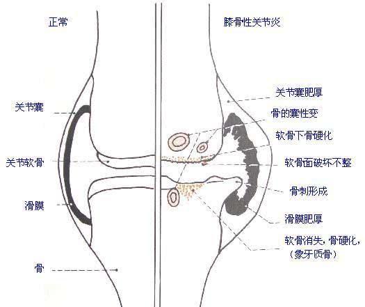 膝关节滑膜炎、关节积液的造成原因